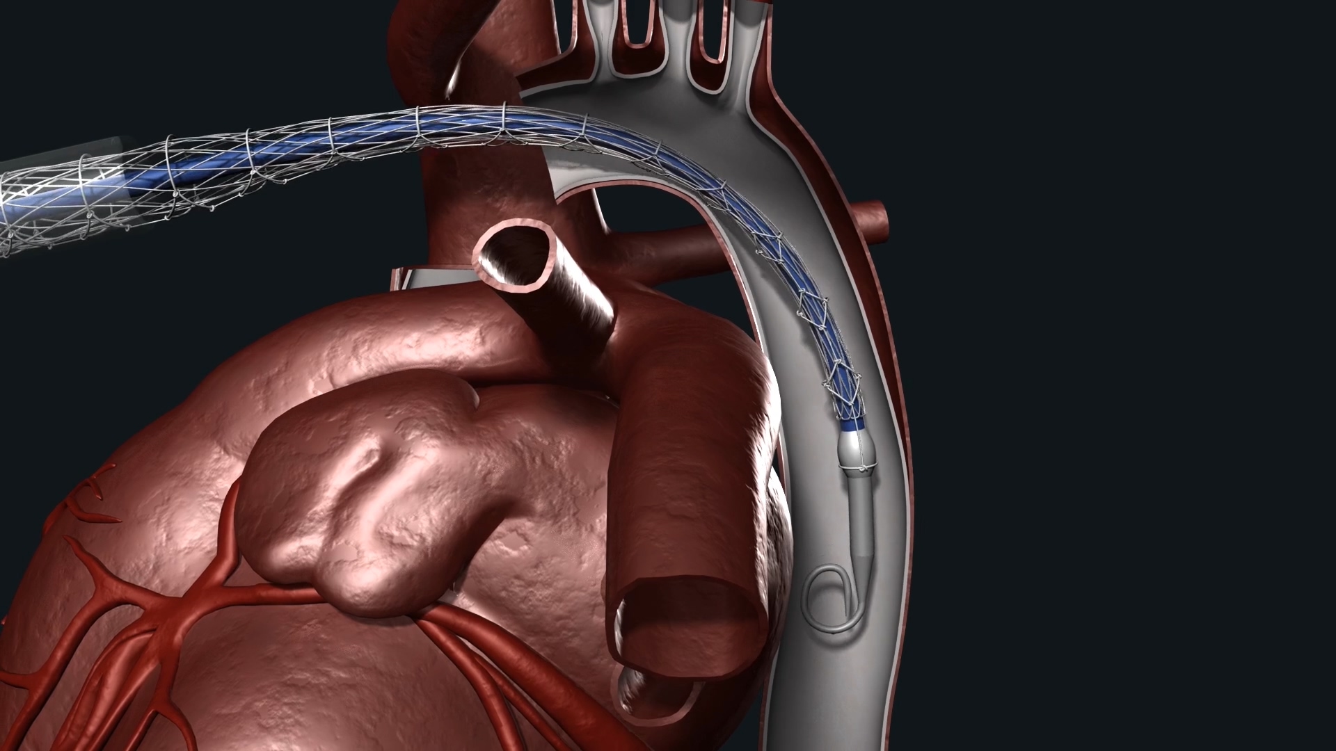心脏搭桥手术动画视频素材