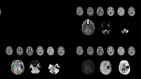 大脑CT扫描图像