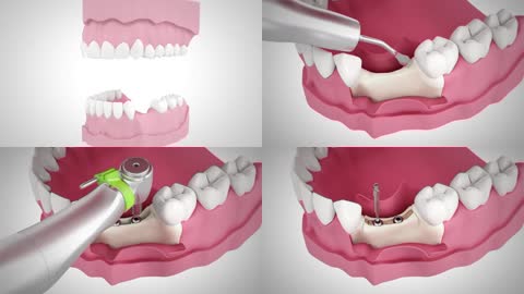 3D口腔科牙槽嵴延伸手术动画
