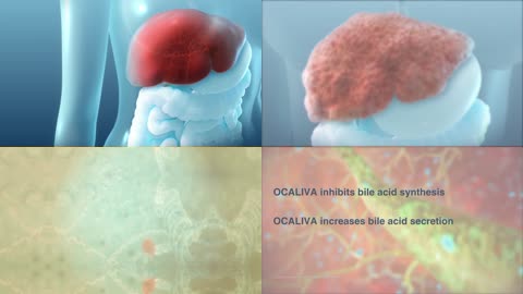 奥贝胆酸Ocaliva肝病药物