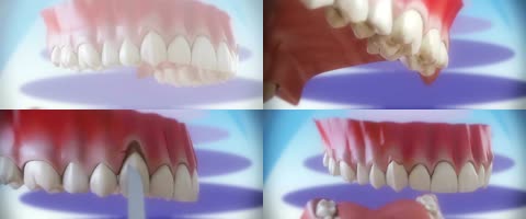 3D牙龈萎缩牙龈退化治疗
