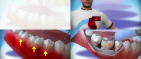 3D牙周炎手术治疗动画