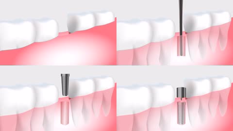 虚拟医学人工植牙植入牙根牙齿过程