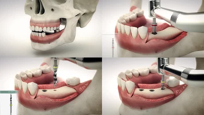牙齿牙医牙科种牙素材