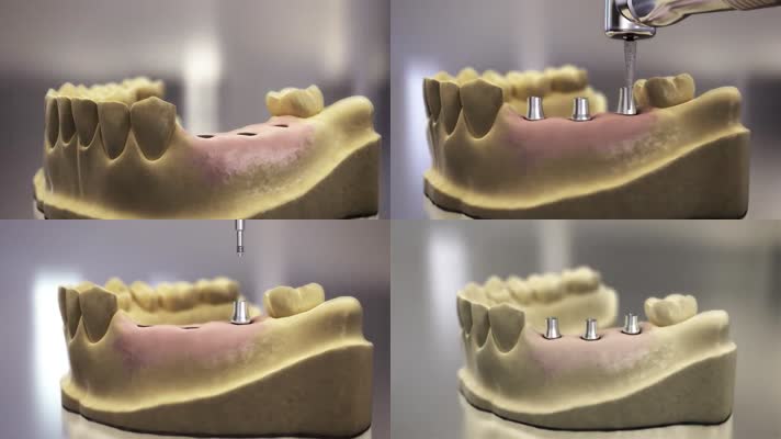 牙齿牙医牙科种牙素材 