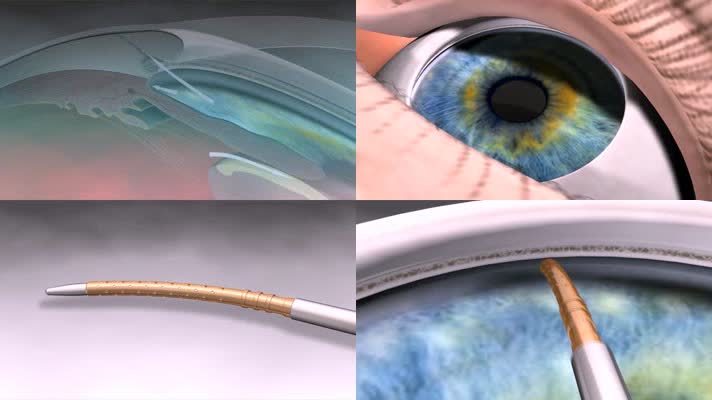Cypass微创支架眼镜植入手术动画