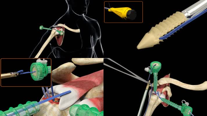 三維醫療異體骨錨釘雙排固定法修復肩袖損傷視頻素材