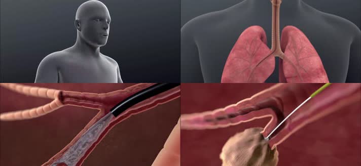 3D支气管镜医疗视频