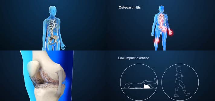 3D骨关节炎关节疾病医疗视频