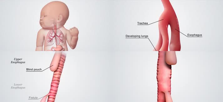3D婴儿气管食管瘘修复手术医疗视频