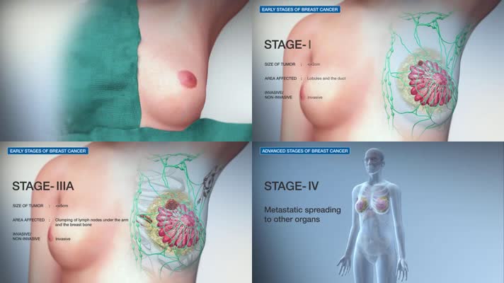 3D乳腺癌分期