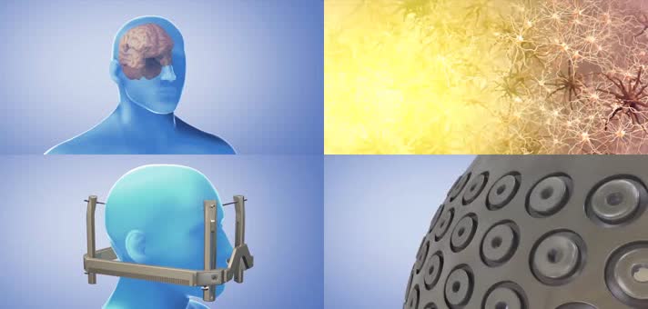 3D治疗肿瘤伽玛刀医疗视频