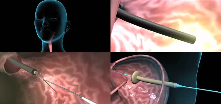 3D肠内喂养经皮内镜胃造口术医疗视频