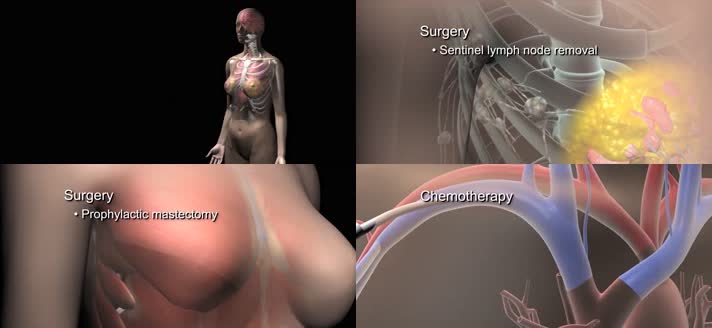 3D治疗乳腺癌医疗视频