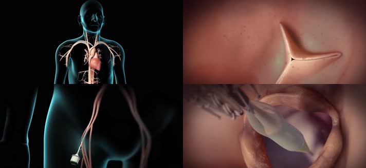 3D经导管主动脉瓣植入术主动脉瓣医疗视频