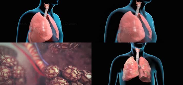3D慢性阻塞性肺疾病医疗视频