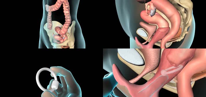 3D盆腔器官脱垂医疗视频