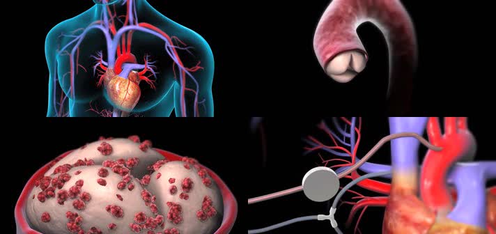 3D心脏主动脉瓣置换术手术医疗视频