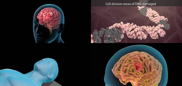 3D调强放射治疗杀死癌细胞医疗视频