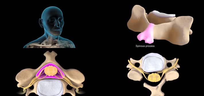 3D颈椎板成形术医疗视频