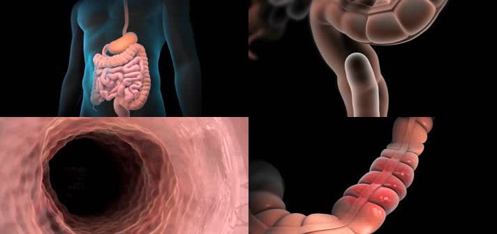 3D结肠癌切除治疗结肠直肠癌医疗视频
