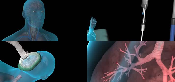 3D全身麻醉医疗视频