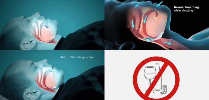 3D睡眠呼吸暂停综合症医疗视频