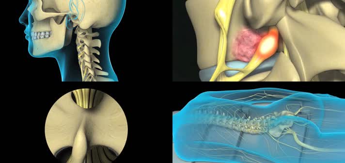 3D腰椎板切除手术脊髓狭窄医疗视频