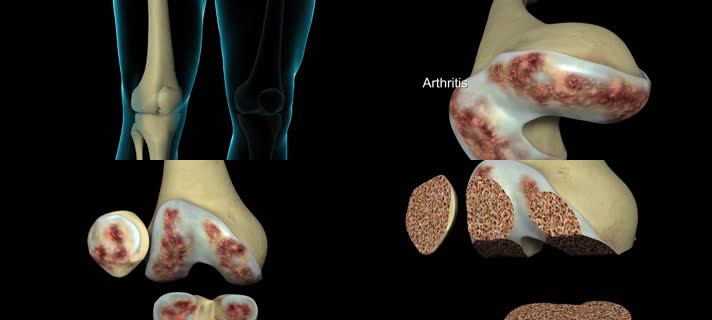 3D膝关节置换技术医疗视频