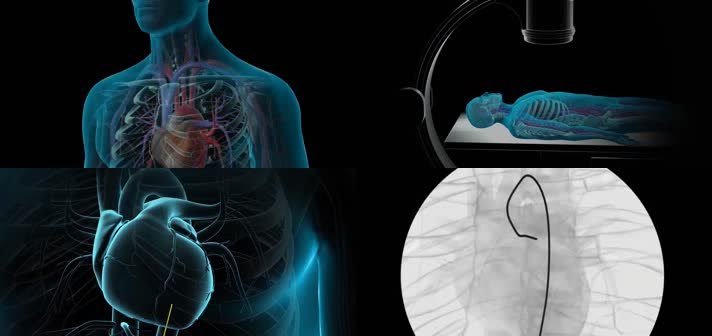 3D冠状动脉造影医疗视频