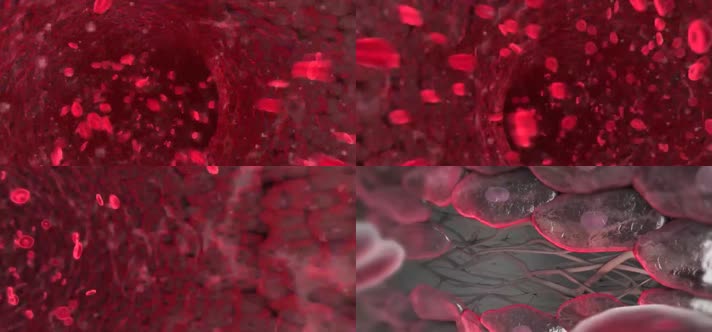 3D动脉粥样硬化引起心脏病医疗视频
