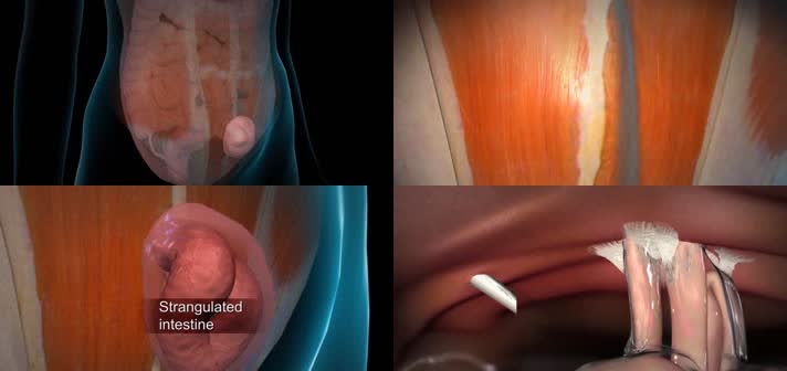 3D切口疝腹腔镜修补手术医疗视频