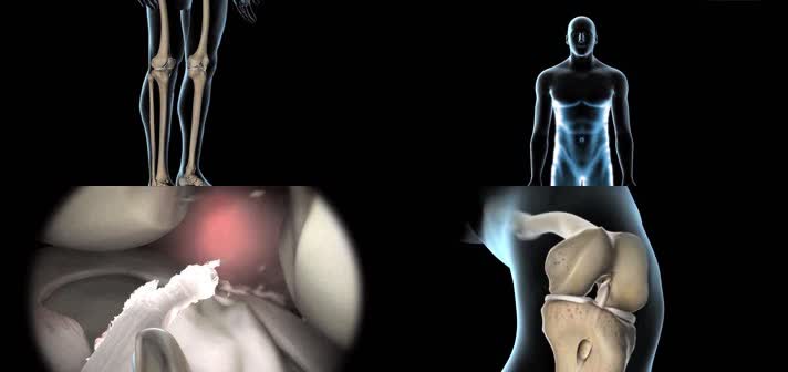 3D膝关节手术医疗动画