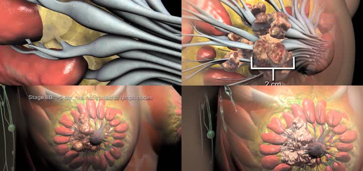 3D乳腺癌进展分期医疗视频