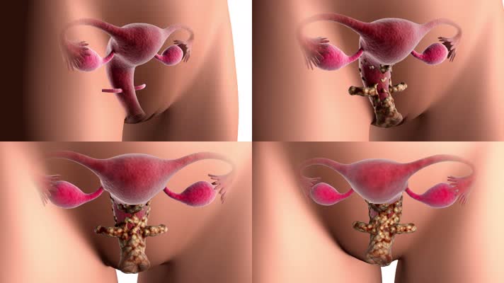 宫颈癌的生物医学