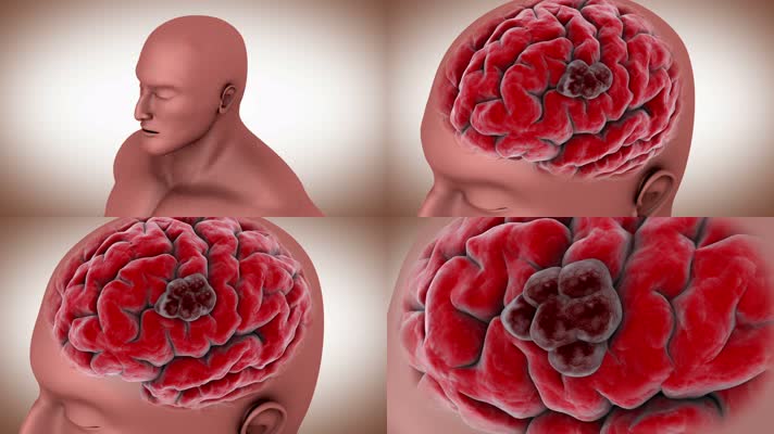 人类大脑中的肿瘤的概念视频