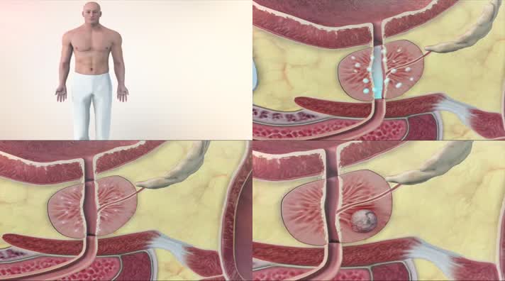前列腺癌剖析人体解剖肌理三维动画
