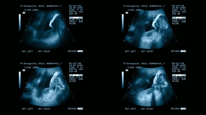 B超彩超孕检胎儿医学影像