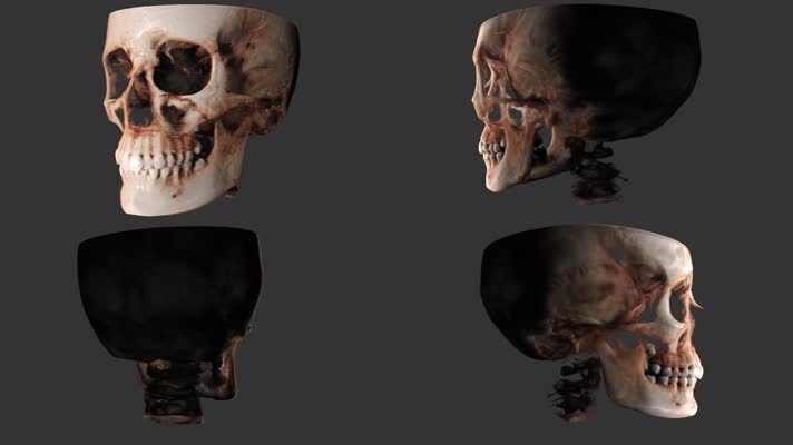 4K骷髅头旋转3D动画医疗三维动画