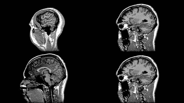 大脑核磁共振矢状面动态影像医学影像
