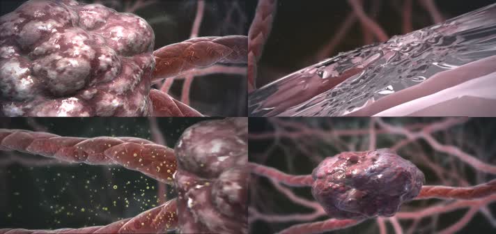 肿瘤血管再生术三维人体肌理病理动画