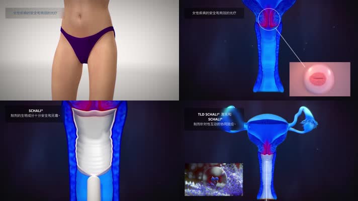 子宫颈疾病治疗妇科疾病医疗三维机理动画