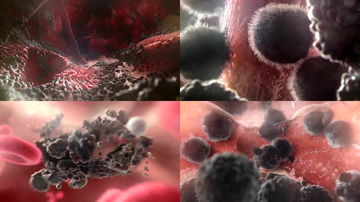新型冠状病毒肺炎癌症细胞扩散细胞病症