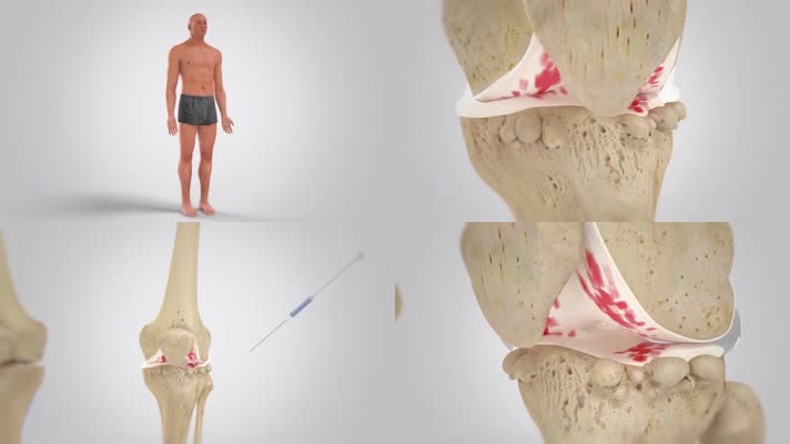 男性关节骨病治疗三维机理动画