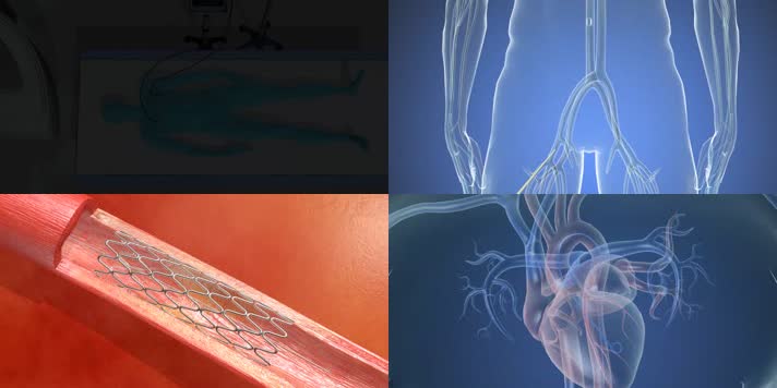 冠心病心血管导管造影术三维医疗动画