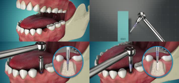 假牙安装牙齿医疗三维动画