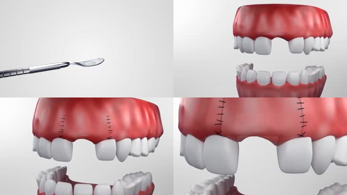 医学种植牙三维动画