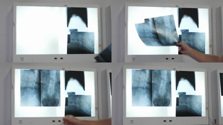 病房灯箱x光片贴x光片医用光片治疗