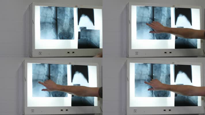 病房灯箱x光片贴x光片医用光片治疗检查
