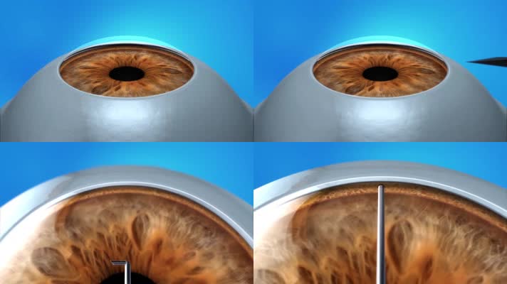 眼部手术动画